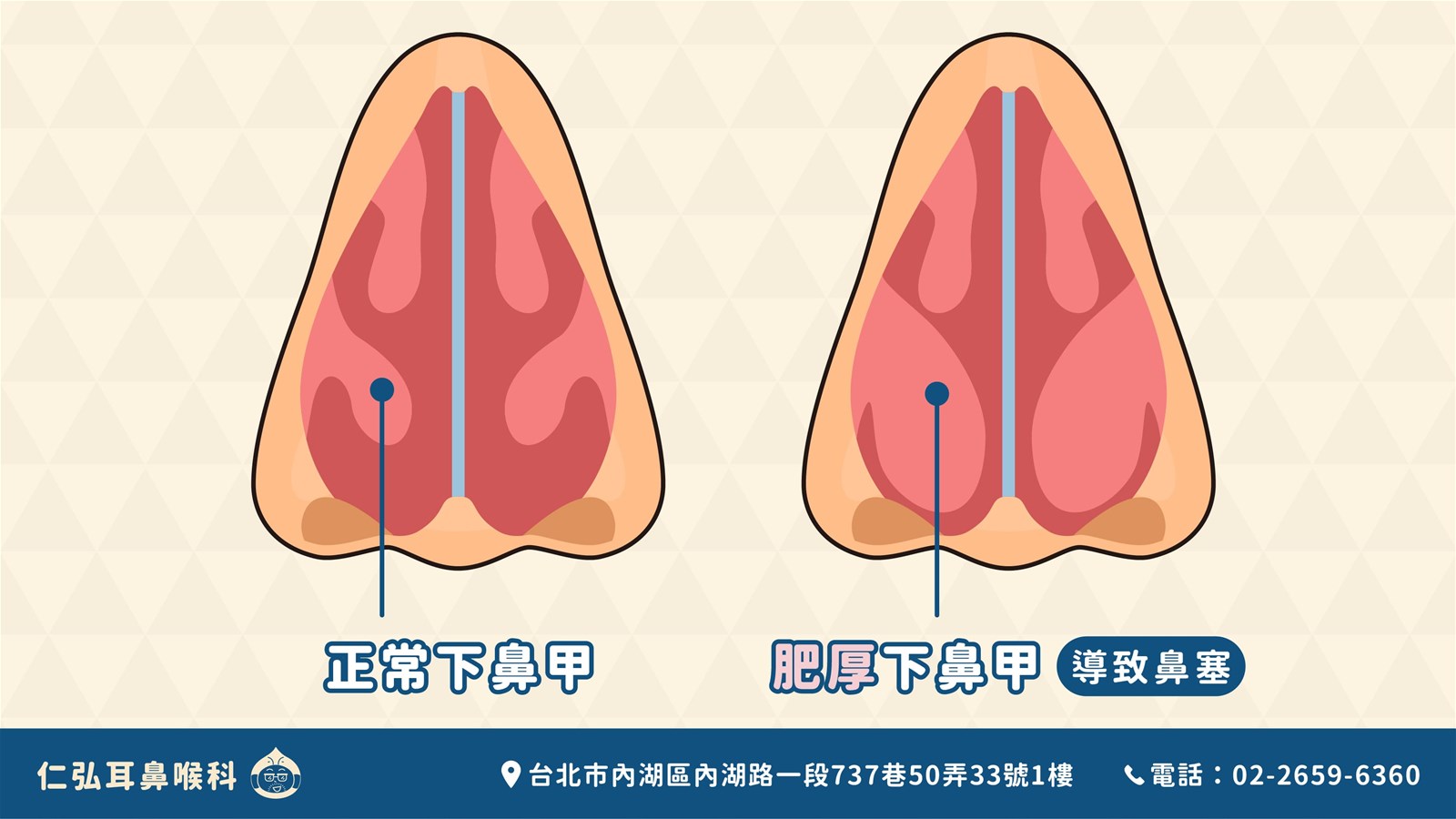 正常下鼻甲與肥厚下鼻甲構造對比圖，顯示肥厚下鼻甲如何阻塞鼻道導致鼻塞。