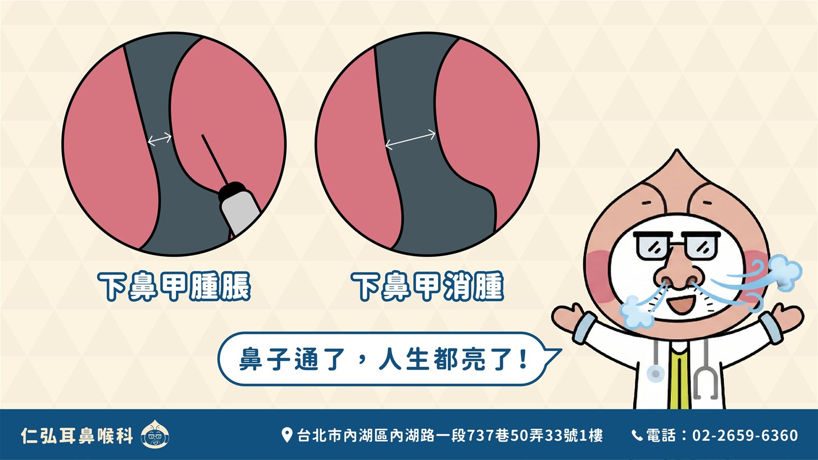 無線射頻下鼻甲成型術術前術後對比，顯示下鼻甲消腫後鼻腔空間變大，呼吸恢復順暢。